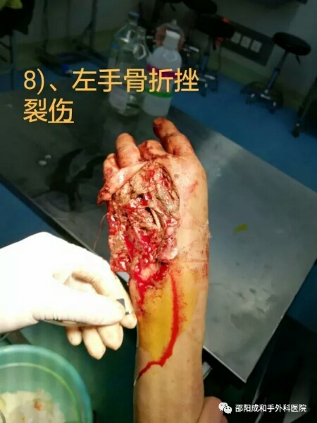 邵陽創(chuàng)傷骨科,邵陽風濕病區(qū),邵陽骨質(zhì)增生,邵陽關(guān)節(jié)病區(qū),邵陽頸椎病區(qū)
