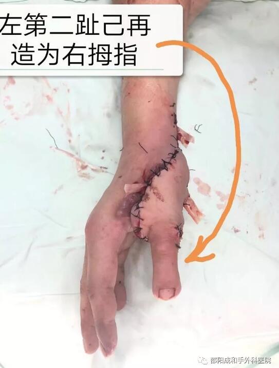 邵陽創(chuàng)傷骨科,邵陽風濕病區(qū),邵陽骨質(zhì)增生,邵陽關節(jié)病區(qū),邵陽頸椎病區(qū)