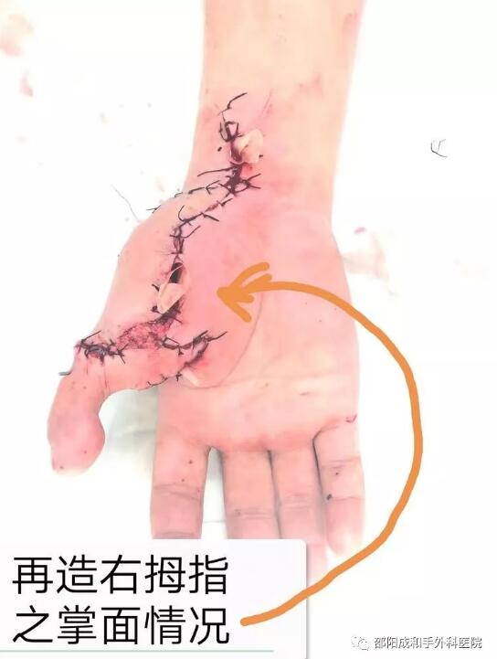 邵陽創(chuàng)傷骨科,邵陽風濕病區(qū),邵陽骨質(zhì)增生,邵陽關節(jié)病區(qū),邵陽頸椎病區(qū)