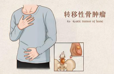 邵陽創(chuàng)傷骨科,邵陽風濕病區(qū),邵陽骨質(zhì)增生,邵陽關(guān)節(jié)病區(qū),邵陽頸椎病區(qū)