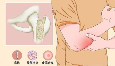 邵陽(yáng)創(chuàng)傷骨科,邵陽(yáng)風(fēng)濕病區(qū),邵陽(yáng)骨質(zhì)增生,邵陽(yáng)關(guān)節(jié)病區(qū),邵陽(yáng)頸椎病區(qū)