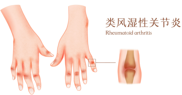 邵陽創(chuàng)傷骨科,邵陽風濕病區(qū),邵陽骨質(zhì)增生,邵陽關節(jié)病區(qū),邵陽頸椎病區(qū)